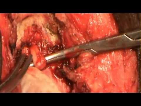 My+Penectomy+Photo EMASCULATION -TOTAL PENECTOMY WITH PERINEAL URETHROSTOMY FOR CA PENIS ...