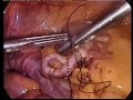 Thumbnail 1 for Apendicitis Aguda Por Laparoscopía Centro Thumbnail 1 for Apendicitis Aguda Por Laparoscopía Centro