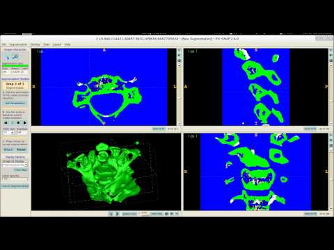 3D vertebrae model creation process, using itk-SNAP