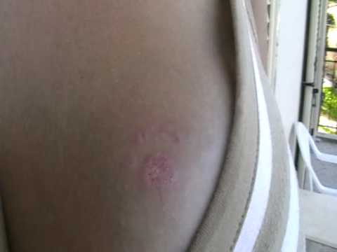 allergic reaction to black henna tattoo after treatment allergic reaction to black henna tattoo after treatment