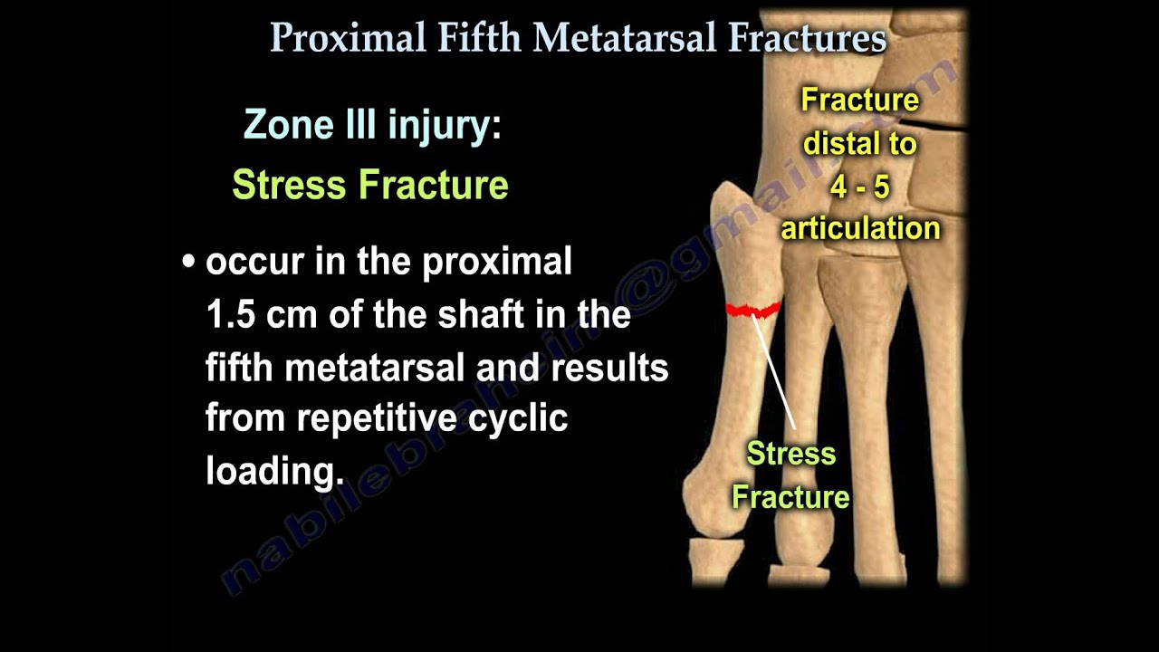 5th metatarsal fracture healing time