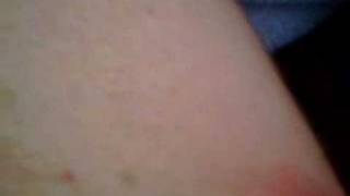 big zit