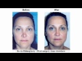 Video: Plastic Surgery - Rhinoplasty