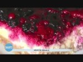 Epatite virale A Epatite virale A