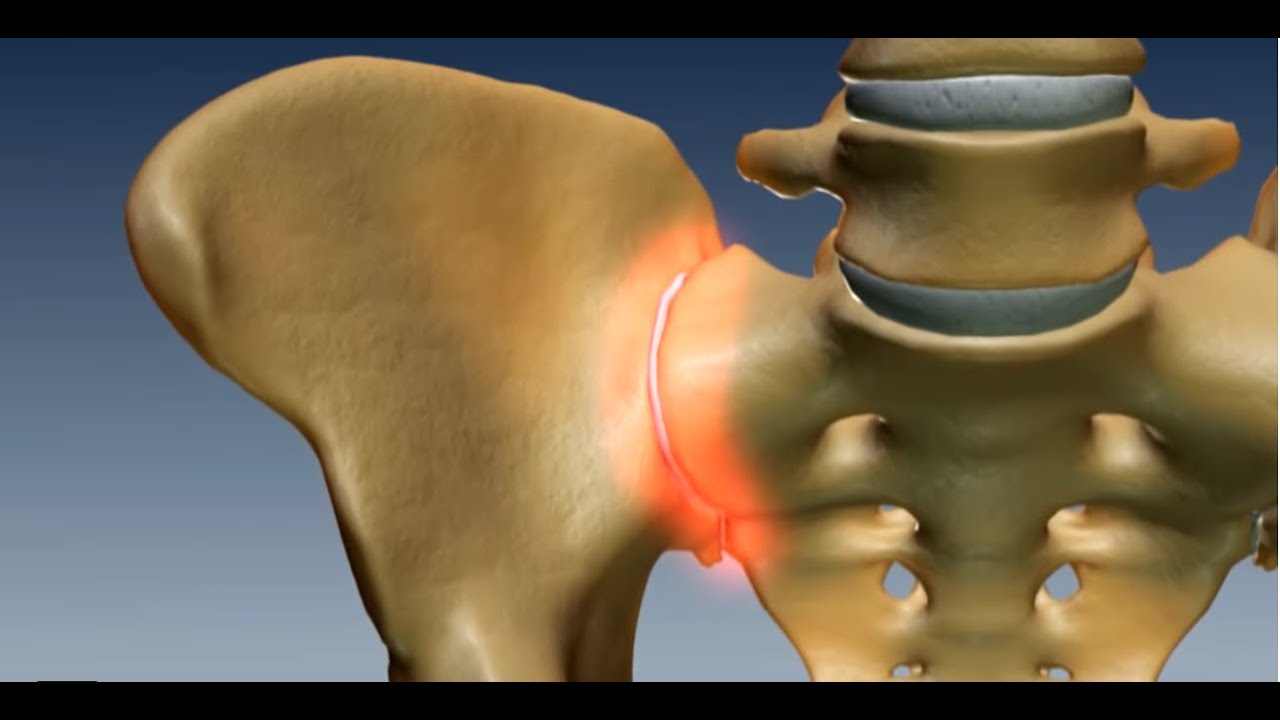 Where is the Sacroiliac Joint? Anatomy of the Sacroilac Joint - YouTube