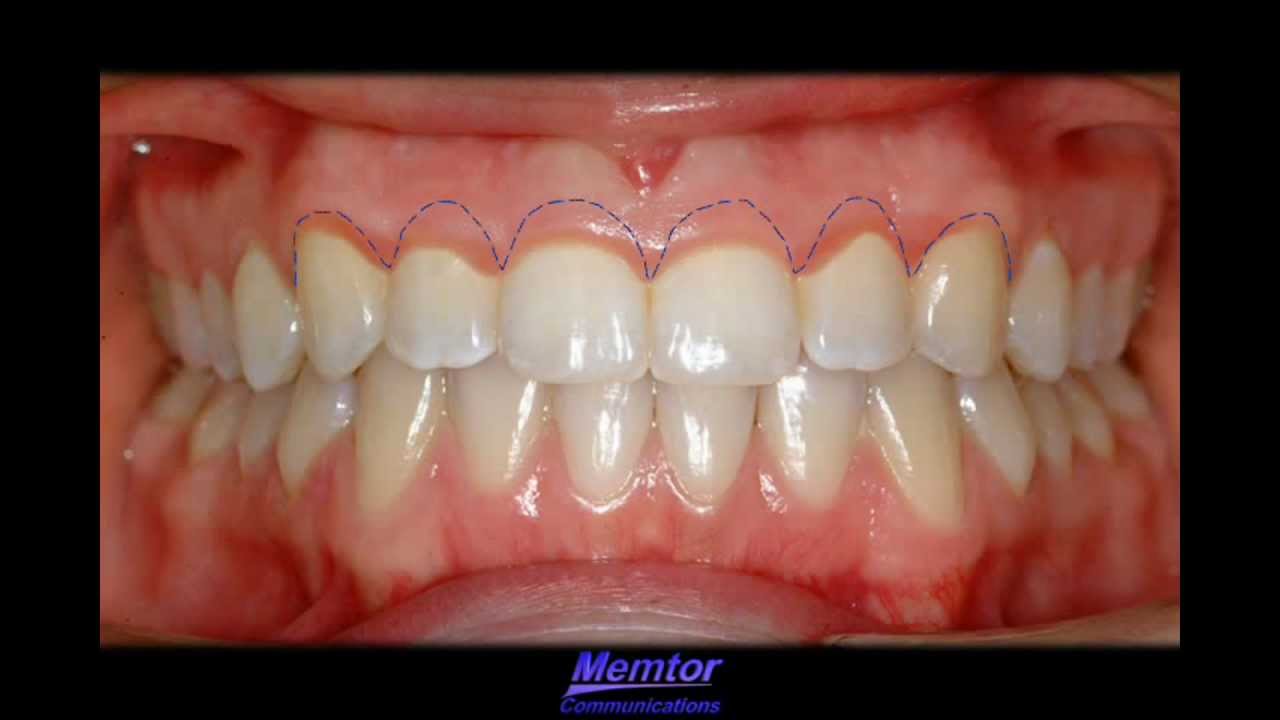 GingivoplastyGingivectomy YouTube