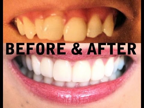 teeth veneers invisalign before whitening crooked straight dental transformation zoom smile perfect whiten ofos implants should cosmetic don laser whitened