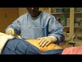 Video: Outer Thigh Liposuction-SmartLipo Of Outer Thigh-Valley Aesthetics-Pankaj Karan,M.D.