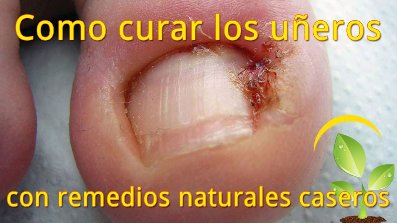 El jugo de limón para el tratamiento del hongo de las uñas