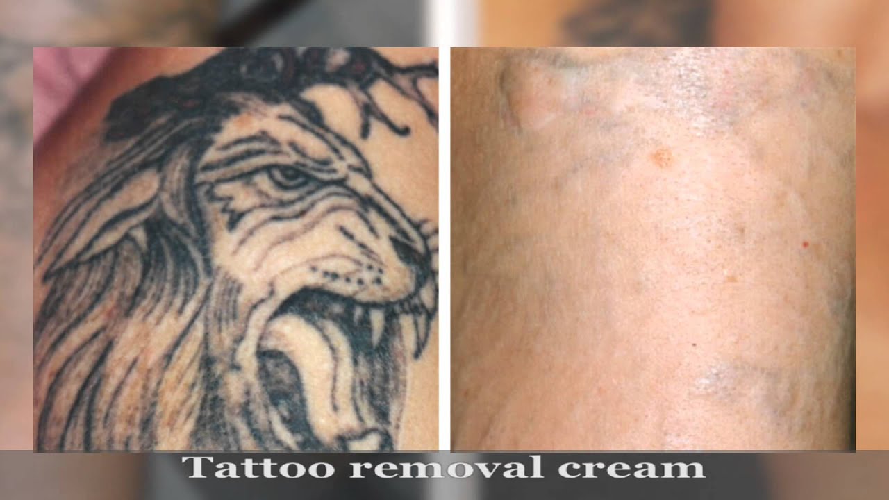 Tattoo removal - YouTube