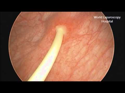 stent cystoscopy double removal mg