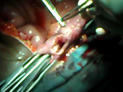 Right hemicolectomy with ileo-transverse anastomosis side to side - YouTube