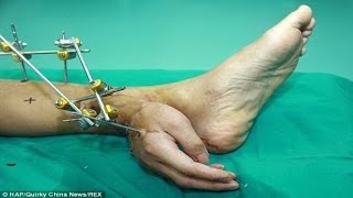 Man whose hand was severed has it attached to his ANKLE for a month being reattached