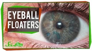 Those Maddening Eyeball Floaters!