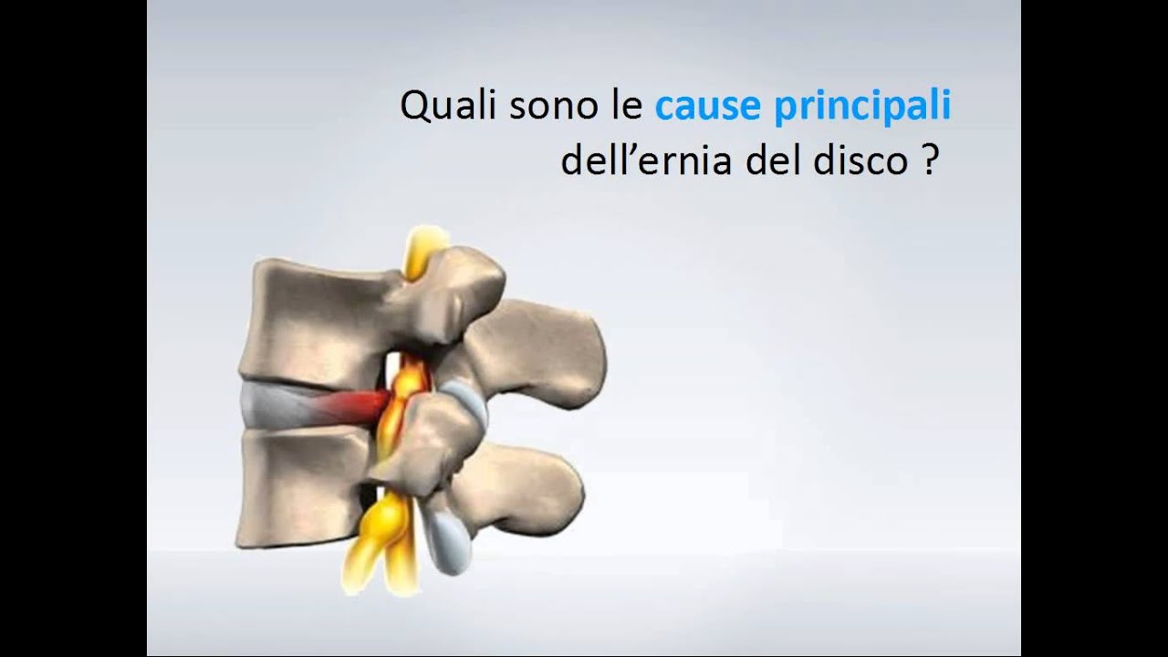 Sintomi di ernie intervertebrali in reparto cervicale