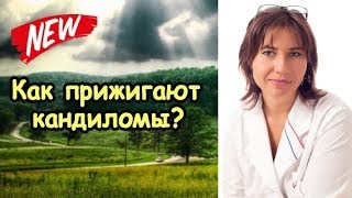 Макарова Екатерина - Как прижигают кондиломы на головке