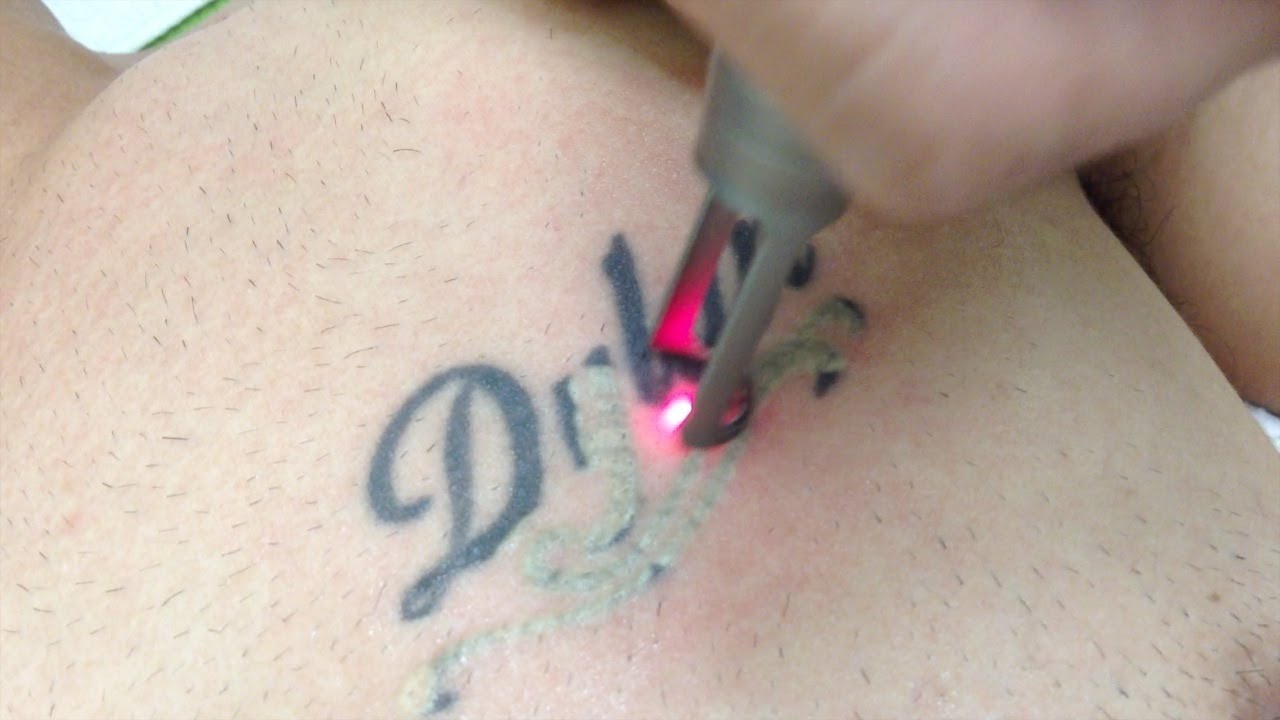 tattoo removal using spectra laser los angeles skin tattoo removal using spectra laser los angeles skin