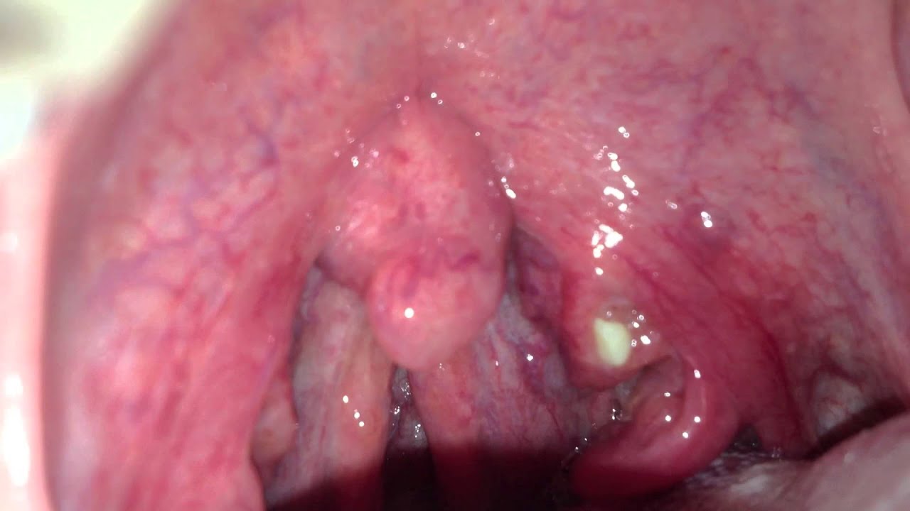 Black Spot On Throat 97