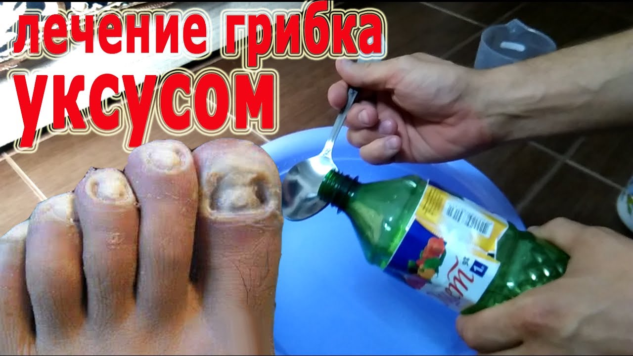 Ютуб как лечить грибок 24