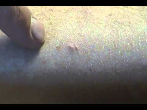 ... | Bed Bug Rash | Bedbug Bites | Pictures of Bed Bug Bites - YouTube