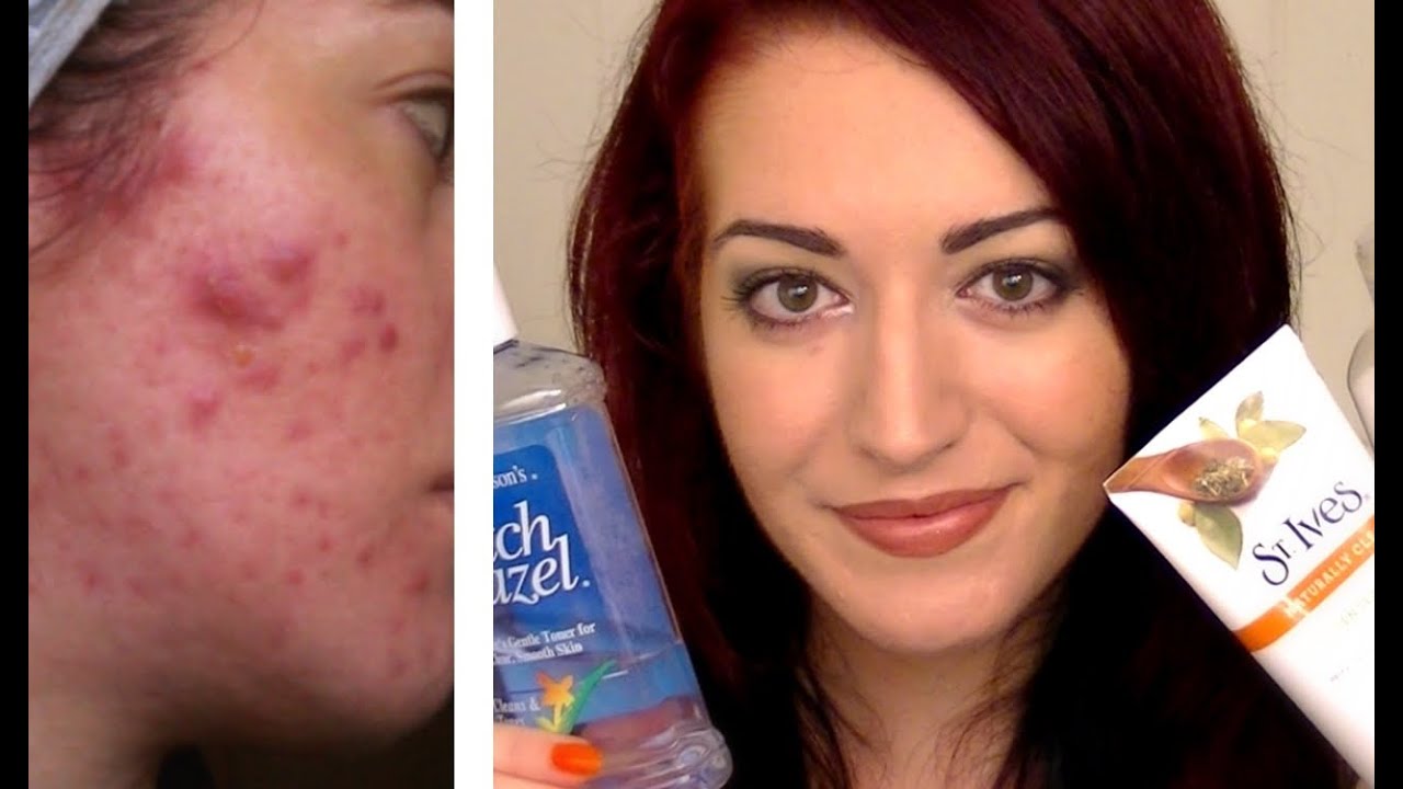 Acne Treatment Red Light Acne Treatment Red Light