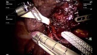 Right Middle Lobectomy