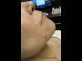 Video: Lips Enhancement-Restylane-Pankaj Karan,M.D.-Valley Aesthetics