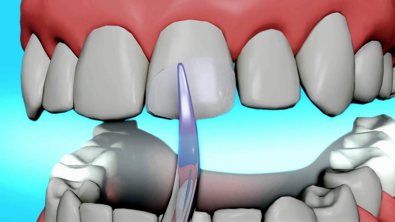 Dental Bonding Video Tooth Bonding YouTube