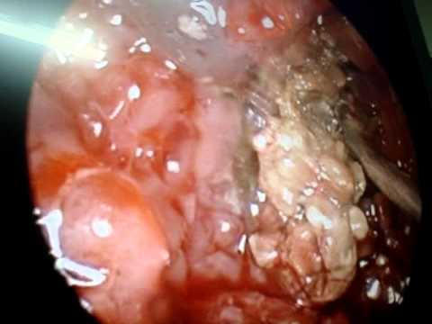 can persistent sinusitis purpose meningitis