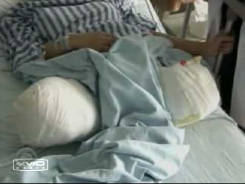 Legless+Women+Amputees ... female amputee DAK double above the knee legless in hospital - YouTube