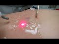 Video: Spider Veins Laser Treatment-Valley Aesthetics-Pankaj Karan,M.D.