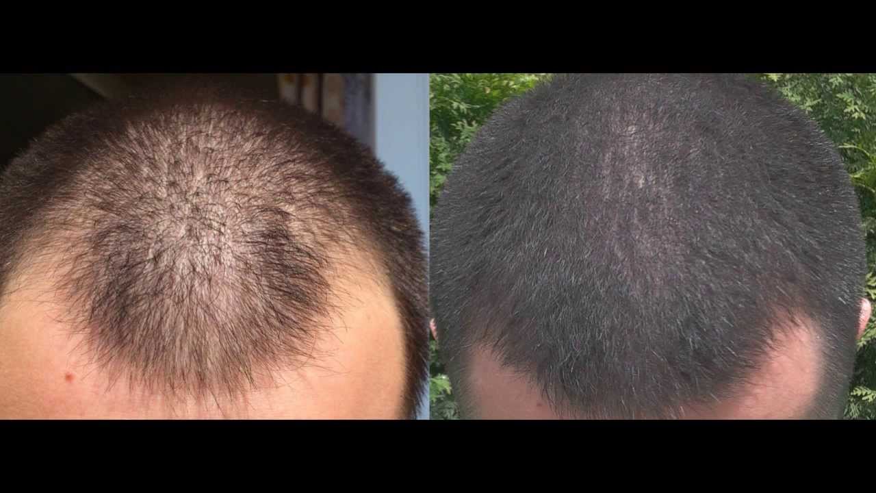 1 year minoxidil hair regrowth results, before and after. 2013! - YouTube