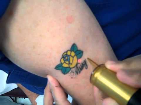 Laser Tattoo Removal: Dr. Bentkover, Candela TriVantage, Worcester and ...