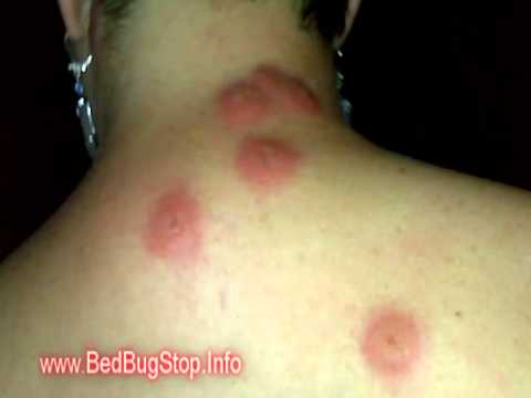 Bed Bug Bites Pictures of Bed Bug Bites - Gross Pictures of Bed Bug ...