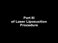 Video: DrTowhidian LASER LIPOSUCTION PART3.wmv