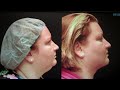 Video: Chin liposuction-Before and After Pictures