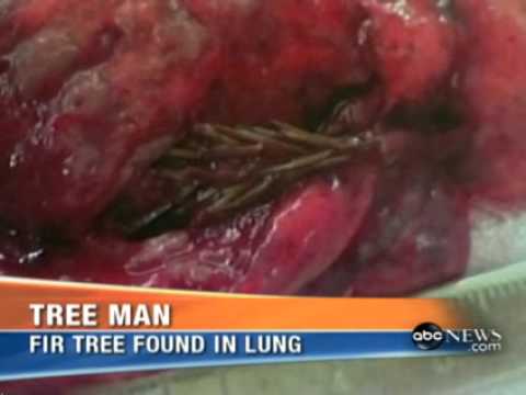 ABC News - Tree Grows Inside Man's Lung - YouTube
