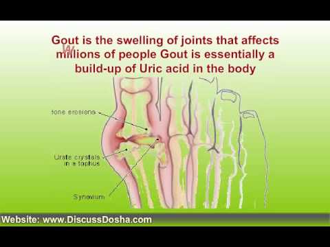 Natural Home Remedies for Gout  The Bout of Gout and Arthritis 