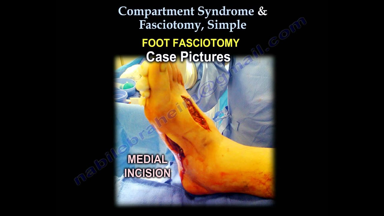 fasciotomy of leg