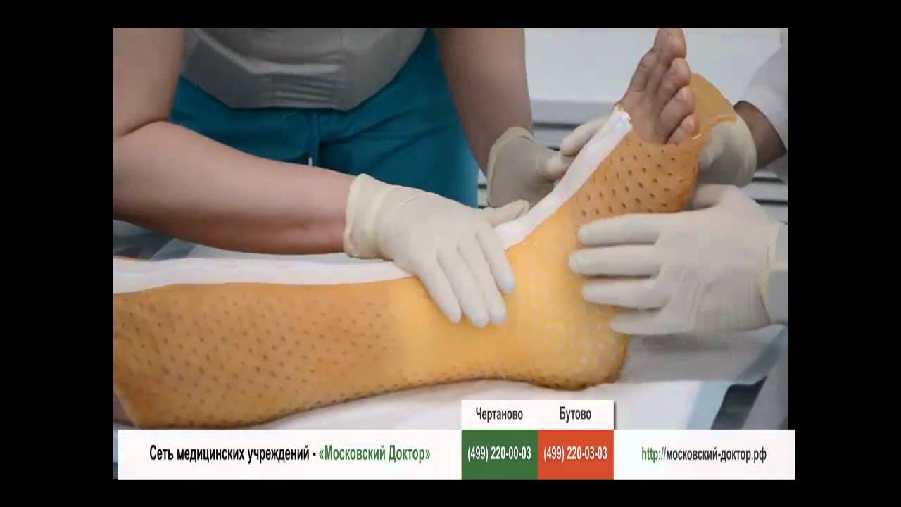 Как самостоятельно снять гипс с перелома Как самостоятельно снять гипс с перелома
