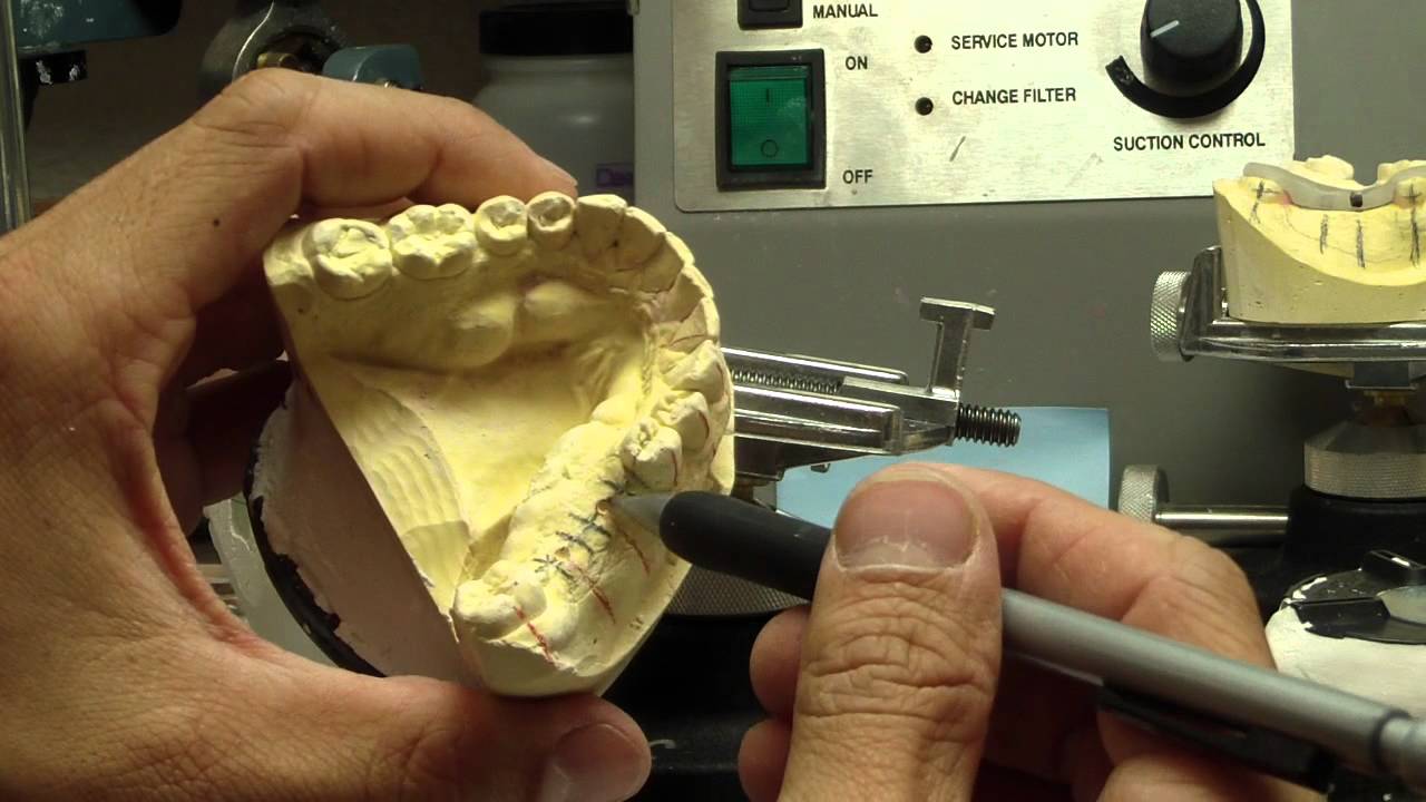 How to Make an Implant Stent Part 1 What you need YouTube