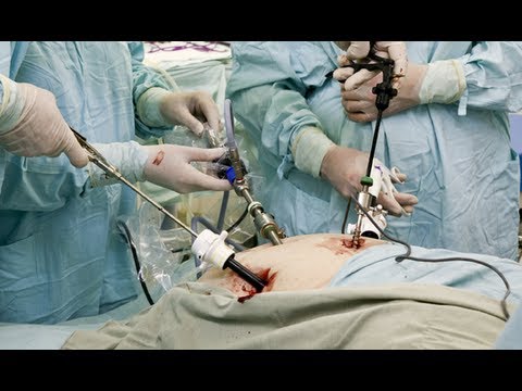 Laparoscopic Cholecystectomy - YouTube