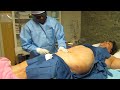 Video: Laser Liposuction-Abdomen-Flanks-Smartlipo Abdomen and Flanks