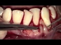 Injerto conectivo para recesiones gingivales