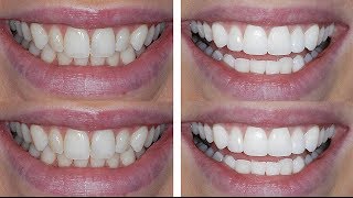 How I Transformed My Teeth!