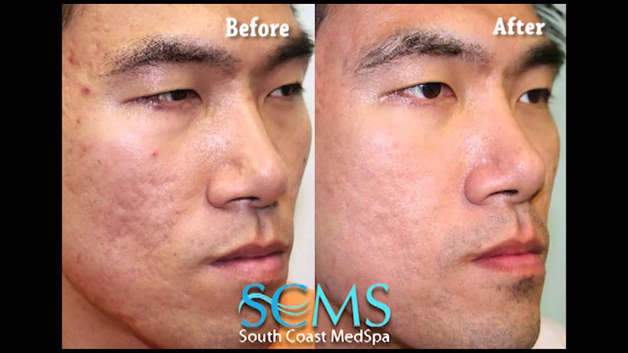 before after asian male newport beach laser acne scar before after asian male newport beach laser acne scar
