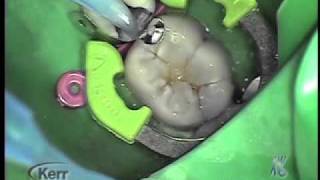 SonicFill System