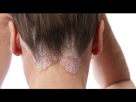 Donde y como puede manifestarse la psoriasis