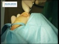 Cirugía de onicocriptosis (Uña encarnada). Ingrown toenail surgery. Winograd modificado