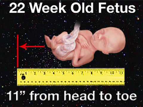 actual 18 week fetus